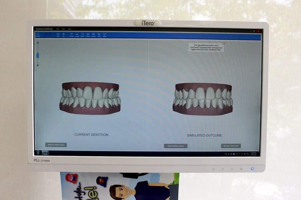 Invisalign mock ups